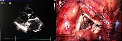 Case Report: Using Medtronic AP360 mechanical prosthesis in mitral valve replacement for patients with mitral insufficiency after primum atrial septal defect repair to reduce left ventricular outflow tract obstruction risk